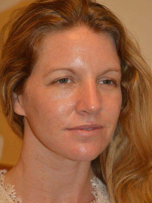 Nose Surgery Case 13840 After Photo Nose Surgery