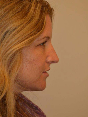 Nose Surgery Case 13840 Before Photo Nose Surgery