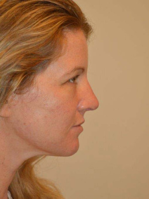 Nose Surgery Case 13840 After Photo Nose Surgery