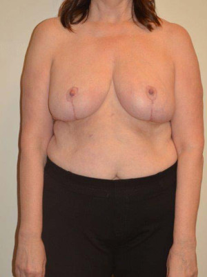 Breast Reduction Case 13816 After Photo Breast Reduction
