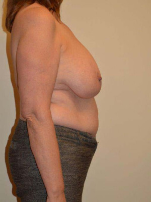 Breast Reduction Case 13816 Before Photo Breast Reduction