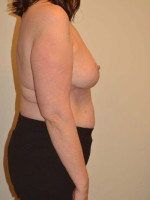 Breast Reduction