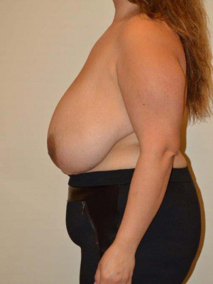 Breast Reduction Case 13749 Before Photo Breast Reduction