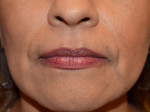 Facial Fat Grafting