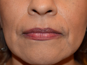 Facial Fat Grafting Case 13755 Before Photo Facial Fat Grafting
