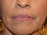 Facial Fat Grafting