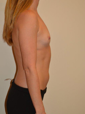 Breast Augmentation Case 13878 Before Photo Breast Augmentation