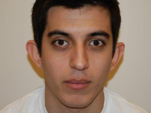 Otoplasty Case 13872 Before Photo Otoplasty