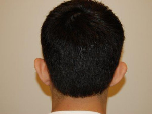 Otoplasty Case 13872 Before Photo Otoplasty