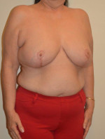 Breast Reduction