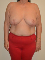 Breast Reduction