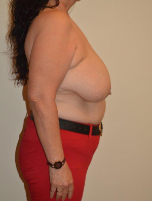 Breast Reduction Case 13985 Before Photo Breast Reduction