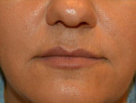 Facial Fat Grafting