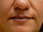 Facial Fat Grafting