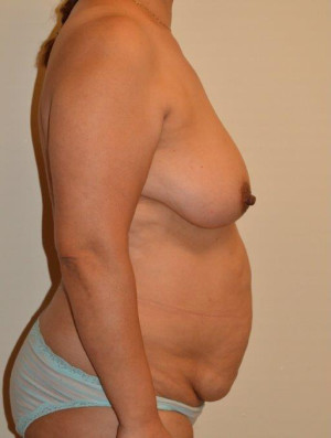 Breast Lift Case 13997 Before Photo Breast Lift