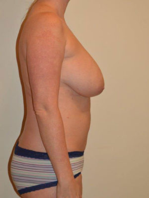 Breast Lift Case 14009 Before Photo Breast Lift