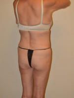 Buttock Augmentation