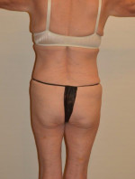 Buttock Augmentation