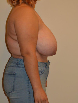 Breast Reduction Case 14023 Before Photo Breast Reduction
