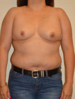 Breast Reconstruction