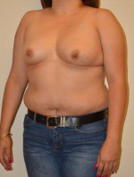 Breast Reconstruction