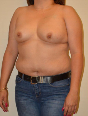Breast Reconstruction Case 14034 Before Photo Breast Reconstruction
