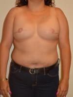 Breast Reconstruction