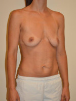 Breast Augmentation with Lift