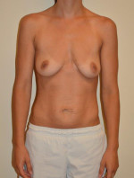 Breast Augmentation with Lift