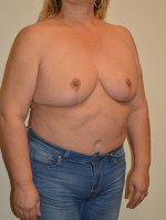 Breast Reduction