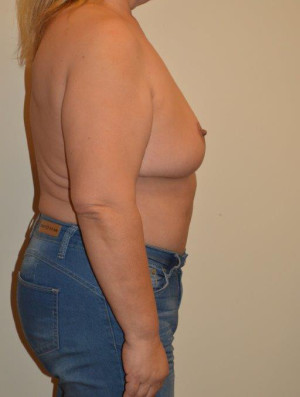Breast Reduction Case 14063 After Photo Breast Reduction