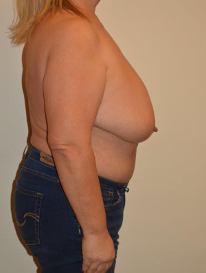 Breast Reduction Case 14063 Before Photo Breast Reduction
