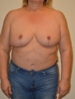 Breast Reduction