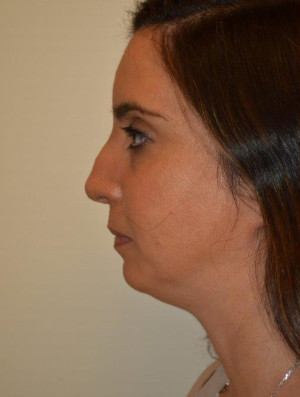 Nose Surgery Case 14078 Before Photo Nose Surgery