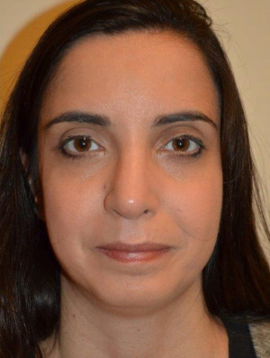 Nose Surgery Case 14078 After Photo Nose Surgery
