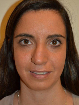 Nose Surgery Case 14078 Before Photo Nose Surgery