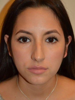 Nose Surgery Case 14080 Before Photo Nose Surgery