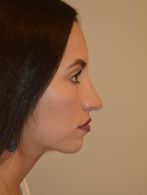 Nose Surgery Case 14080 After Photo Nose Surgery