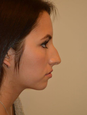 Nose Surgery Case 14080 Before Photo Nose Surgery