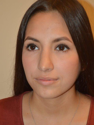 Nose Surgery Case 14080 Before Photo Nose Surgery