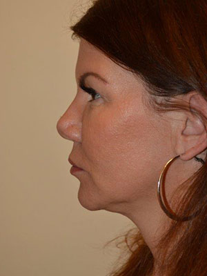 Nose Surgery Case 14210 After Photo Nose Surgery
