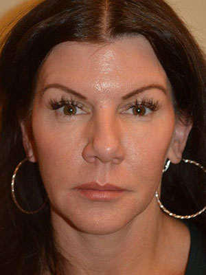 Nose Surgery Case 14210 Before Photo Nose Surgery