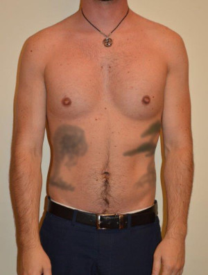 Male Pectoral Implants