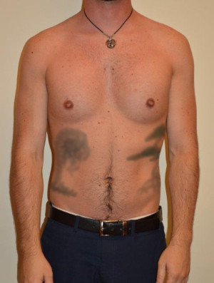 Male Pectoral Implants Case 14234 After Photo Male Pectoral Implants