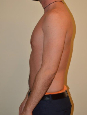 Male Pectoral Implants Case 14234 Before Photo Male Pectoral Implants