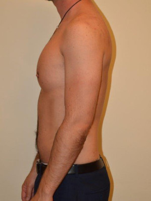 Male Pectoral Implants Case 14234 After Photo Male Pectoral Implants