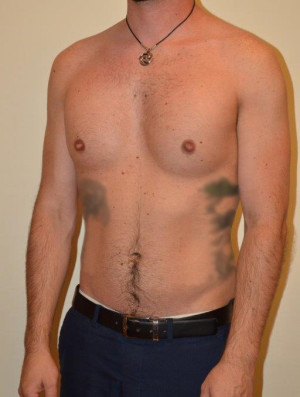 Male Pectoral Implants Case 14234 After Photo Male Pectoral Implants