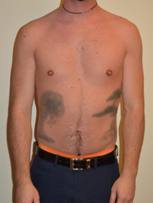 Male Pectoral Implants Case 14234 Before Photo Male Pectoral Implants