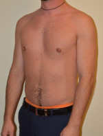 Male Pectoral Implants