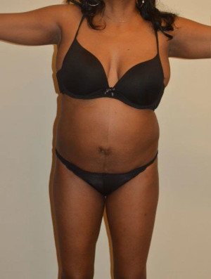 Liposuction Case 14253 Before Photo Liposuction